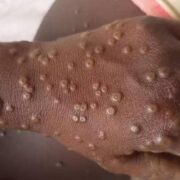 Entre le 14 novembre 2025 et le 7 janvier 2026, cinq cas ont été détectés au Cameroun selon un communiqué rendu public ce 13 janvier par le Dr Manaouda Malachie, ministre de la Santé publique.