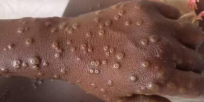 Entre le 14 novembre 2025 et le 7 janvier 2026, cinq cas ont été détectés au Cameroun selon un communiqué rendu public ce 13 janvier par le Dr Manaouda Malachie, ministre de la Santé publique.