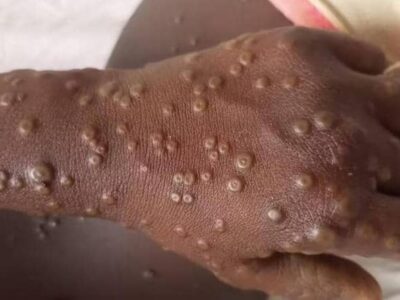 Entre le 14 novembre 2025 et le 7 janvier 2026, cinq cas ont été détectés au Cameroun selon un communiqué rendu public ce 13 janvier par le Dr Manaouda Malachie, ministre de la Santé publique.