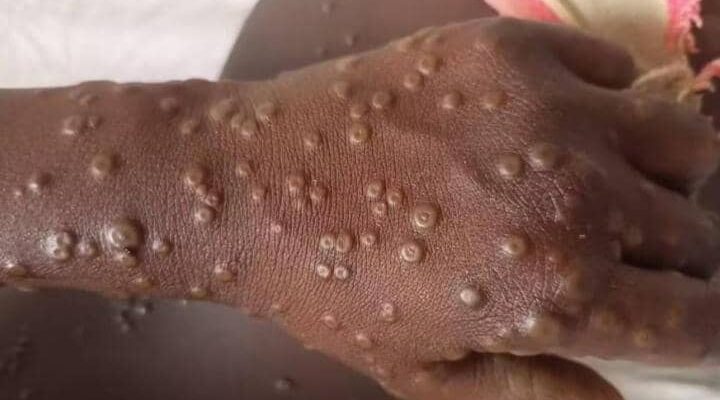 Entre le 14 novembre 2025 et le 7 janvier 2026, cinq cas ont été détectés au Cameroun selon un communiqué rendu public ce 13 janvier par le Dr Manaouda Malachie, ministre de la Santé publique.